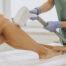 Cutera laser hair removal